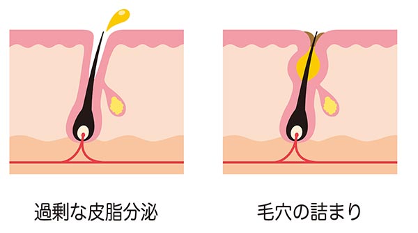 過剰な皮脂分泌から毛穴が詰まるまで